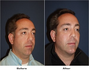Facial plastic surgery in Charlotte NC