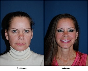 Facial plastic surgeon - Charlotte NC